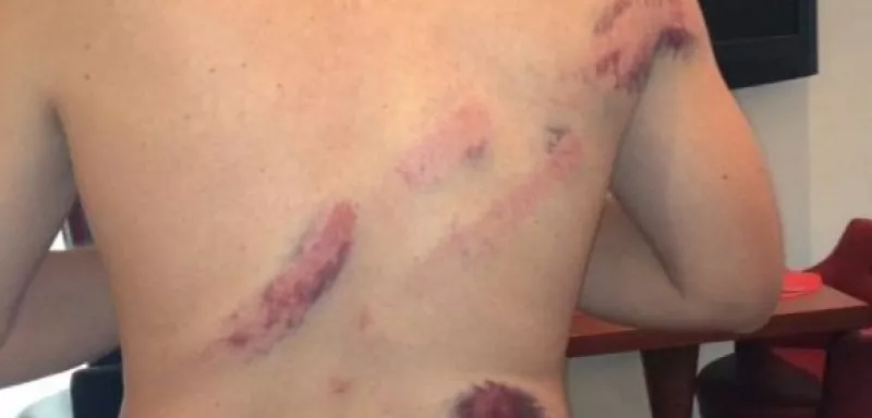 Des bras cassés, des cranes ouverts et beaucoup de bleus, pour rien, pour les supporters montpelliérains, qui commencent à diffuser les photos de leurs blessures... (DR) Des bras cassés, des cranes ouverts et beaucoup de bleus, pour rien, pour les supporters montpelliérains, qui commencent à diffuser les photos de leurs blessures... (DR)