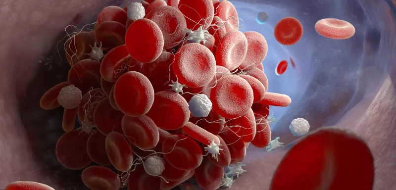 Les scientifiques ont identifié une raison possible pour laquelle le vaccin AstraZeneca peut provoquer des caillots sanguins (Photo : DR) 